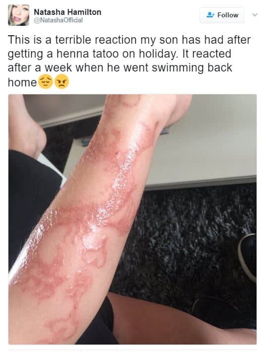 henna-tattoo-reaction