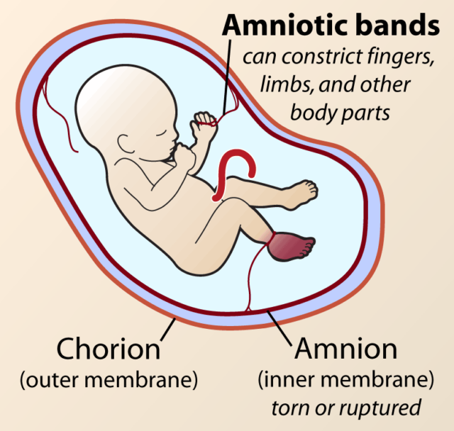 amniotic band syndrome